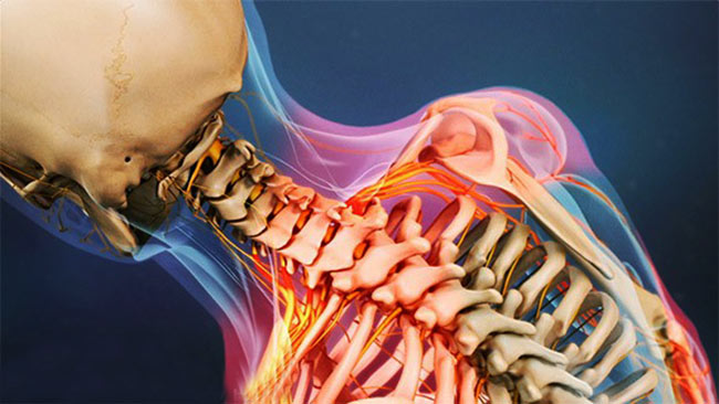دیسک گردن: علائم و درمان بدون جراحی