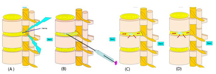 تزریق دیسکوژل