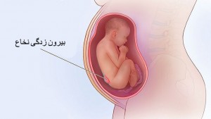 اسپینا بیفیدا یا بیرون زدگی نخاع