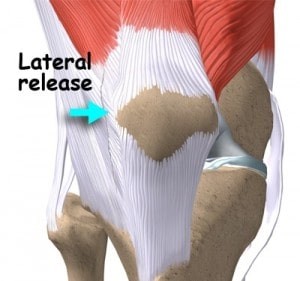 جراحی غضروف کشکک زانو