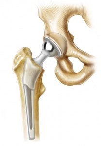 خشک کردن مفصل (جوش دادن استخوان)