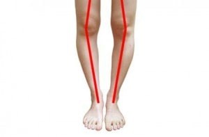 درمان زانو و پای پرانتزی در کودکان و بزرگسالان