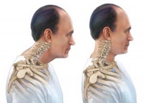 درمان قوس گردن (سر و گردن به جلو) با طب فیزیکی و ورزش