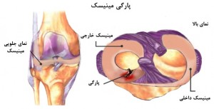 درمان پارگی و آسیب منیسک زانو بدون جراحی با روش های طب فیزیکی