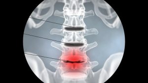 دیسکوگرافی کمر