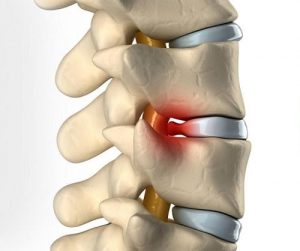 علائم دیسک گردن