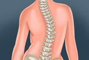 علائم و درمان انحراف و کجی ستون فقرات (اسکولیوز) با طب فیزیکی