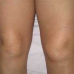 علت-ورم-آب-آوردن-زانوو-درمان-آن-min-150x150