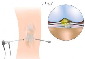 عمل جراحی آرتروسکوپی زانو