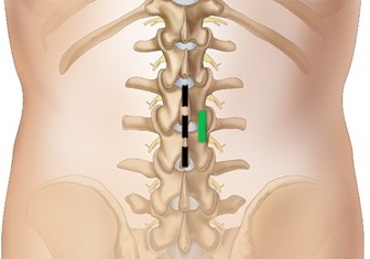 قدم دوم - ایجاد برش جراحی