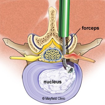 قدم چهارم - برداشتن قطعات متلاشی شده دیسک