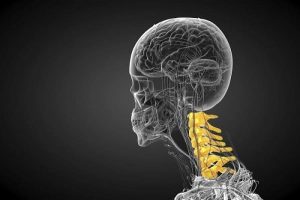 قوس گردن خطرناک است؟ درمان انحنای زیاد گردن بدون جراحی