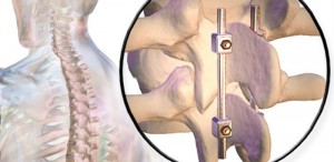 مراحل انواع عمل فیوژن ستون فقرات (پیوند استخوان ستون فقرات)