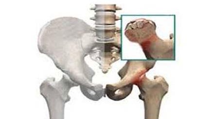نکروز یا سیاه شدن سر استخوان ران