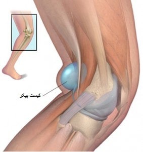ورم پشت زانو و کیست بیکر