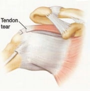 پارگی تانون روتاتور کاف