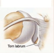 پارگی های لابروم شانه